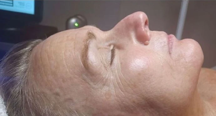 Hautbild nach dem ersten HydraFacial® Treatment
