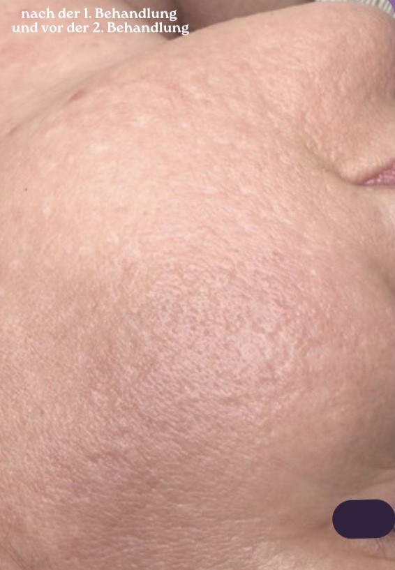 Wangenpartie nach der ersten Microneedling-Behandlung mit Dermapen Pro