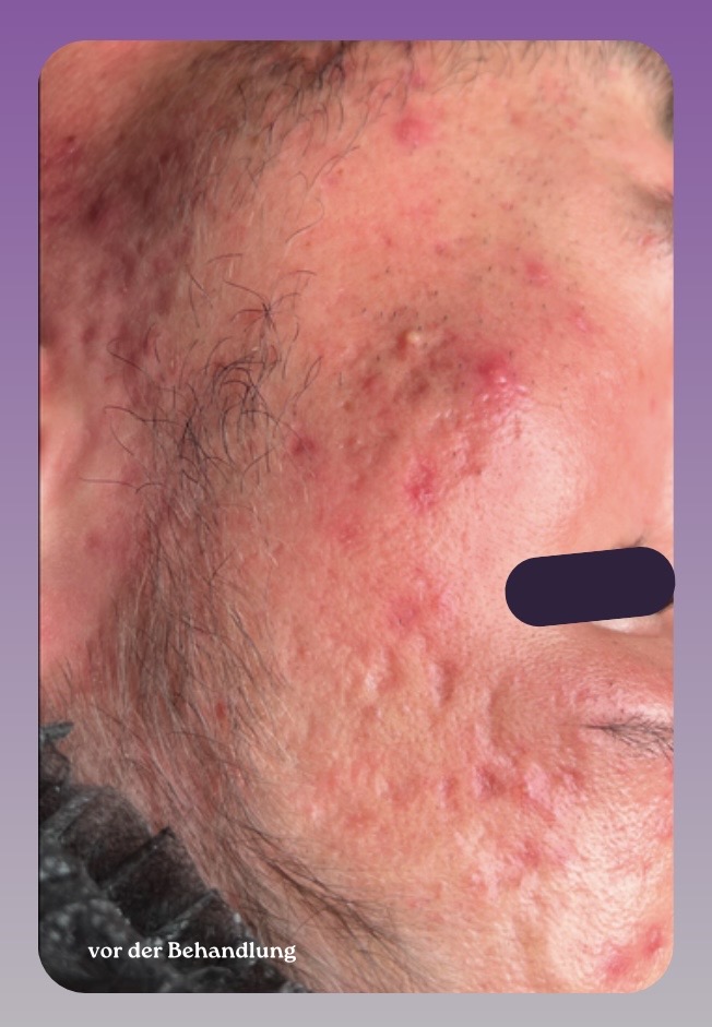 Hautbild vor dem WOW Signature Treatment