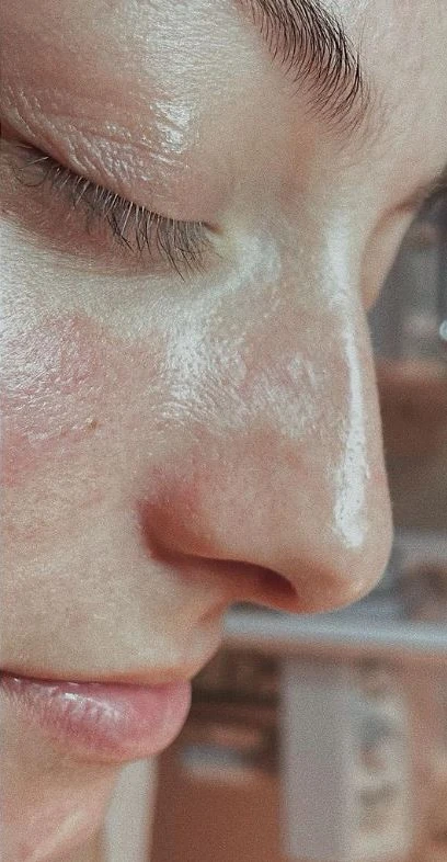 Hautbild nach dem zweiten HydraFacial® Treatment