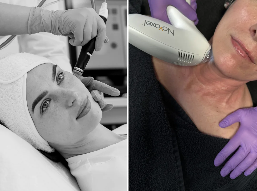 Kombinierte Mezotix® und HydraFacial® Behandlung bei WOW Studios Düsseldorf